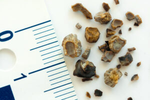 kidney stones on white table next to ruler