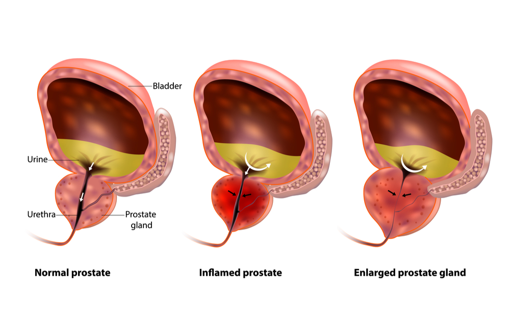 illustration comparing normal prostate, inflamed prostate, and enlarged prostate